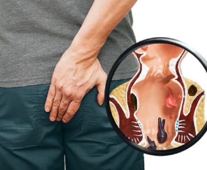 Áp xe hậu môn do đâu mà có?